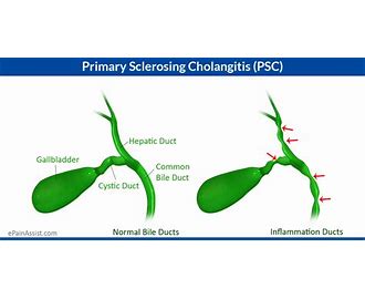 Primary Sclerosing Cholangitis PSC