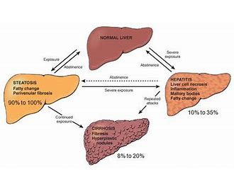 Alcoholic Liver Disease ALD