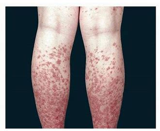 Idiopathic Thrombocytopenic Purpura ITP