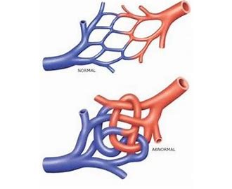 Arterio Venous Malformation AVM
