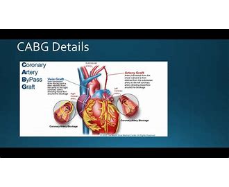 CABG