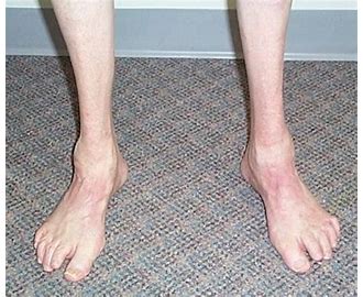 Charcot Marie Tooth CMT