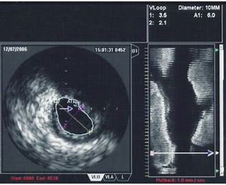 IntraVascular UltraSound IVUS