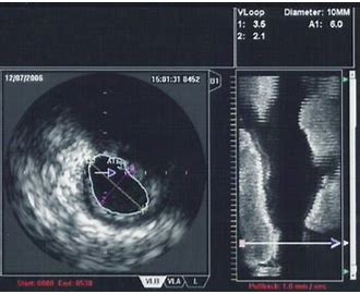 IVUS