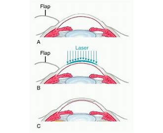 Laser-Assisted Stromal In-situ Keratomileusis LASIK