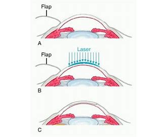 LASIK