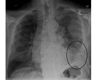 Malignant Mesothelioma MM