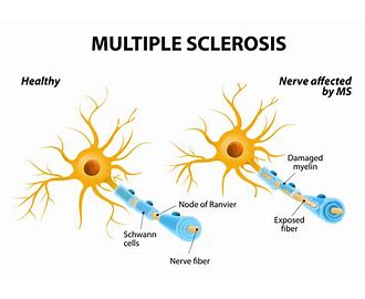 Multiple Sclerosis MS