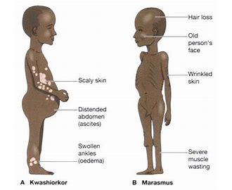 Protein Energy Malnutrition PEM