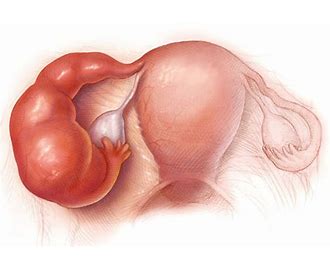 Pelvic Inflammatory Disease PID