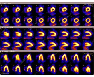 Single Photon Emission Computed Tomography SPECT