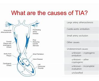 Transient Ischemic Attack TIA