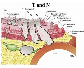 Tumor, Node, Metastases TNM