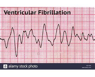 Ventricular Fibrilation VF